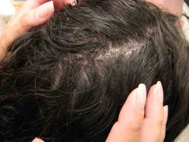 Cara Menghilangkan Kutu Rambut dan Telurnya Sampai Tuntas
